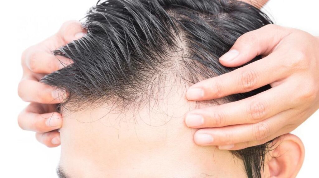 Best Hair Loss Treatment Doctors in Hyderabad | La Picasso